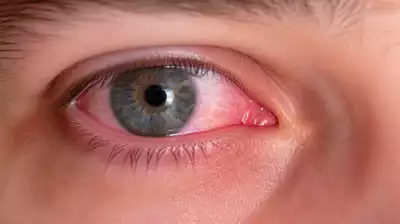 Product image related to eye infections